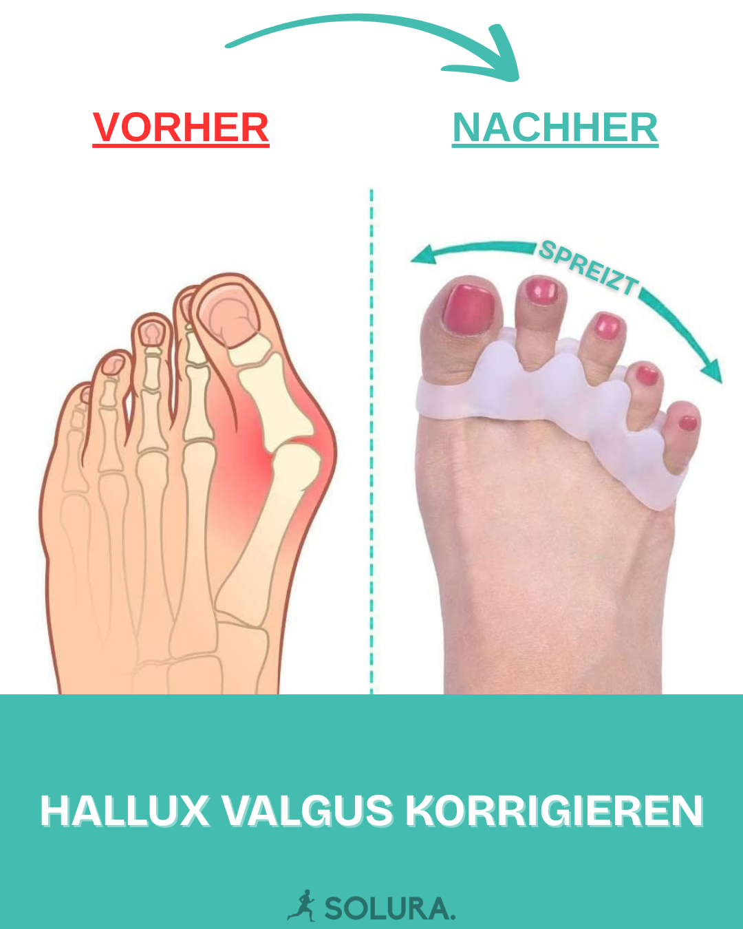 SOLURA Zehenspreizer – Gegen Hallux & Fußschmerzen